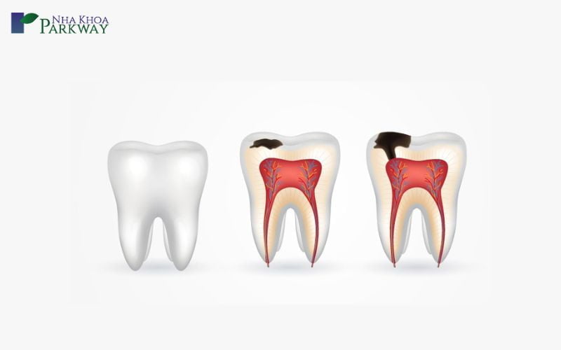 Nhận biết về tình trạng sâu răng
