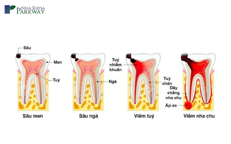 Răng bị sâu nhưng không đau là gì?