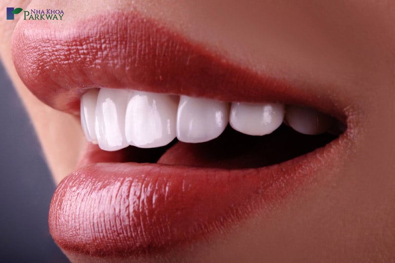 Cô gái có nụ cười tự tin với hàm răng trắng sáng và thẳng tắp sau khi hoàn tất trồng răng implant