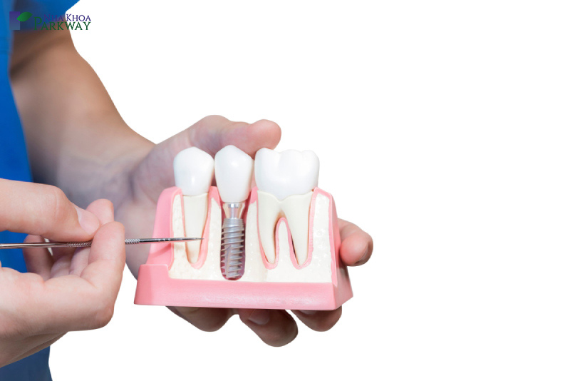 Hình ảnh mô phỏng răng implant được trồng