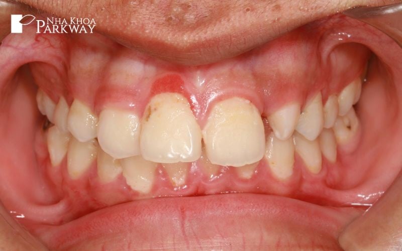 Hình ảnh chân răng bị nổi cục trắng và nướu chân răng bị đỏ