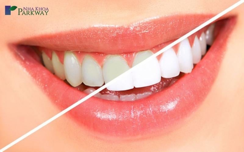 Hình ảnh răng trước và sau khi tẩy trắng