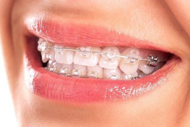 Yếu tố ảnh hưởng đến giá niềng răng mắc cài sứ