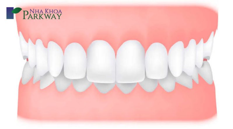 Một vài nguyên nhân răng bị hô nhẹ thường gặp