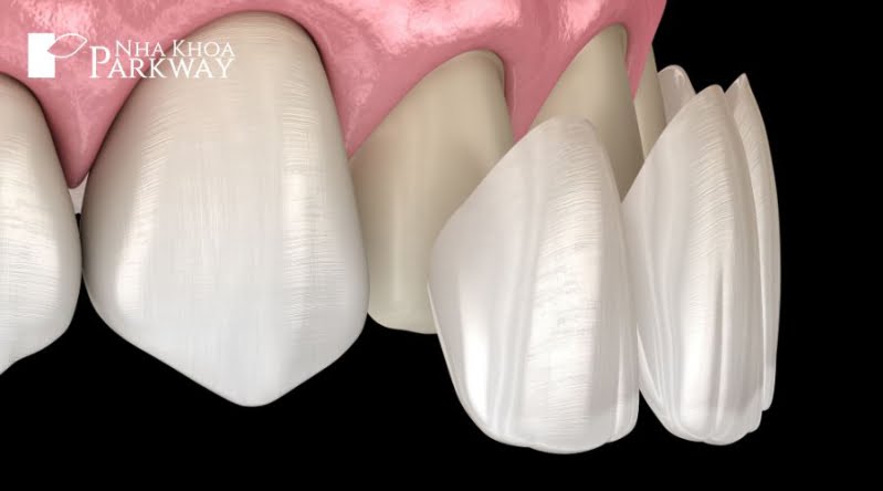 Phương pháp dán sứ Veneer - chỉnh răng hô không cần niềng