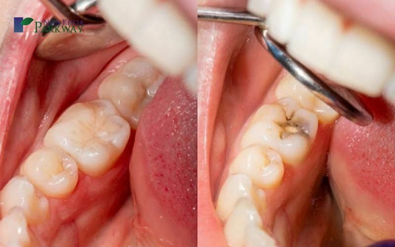 Bác sĩ dùng gương nha khám răng hàm bị sâu nhẹ
