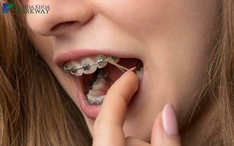 Cô gái niềng răng và sử dụng thun liên hàm