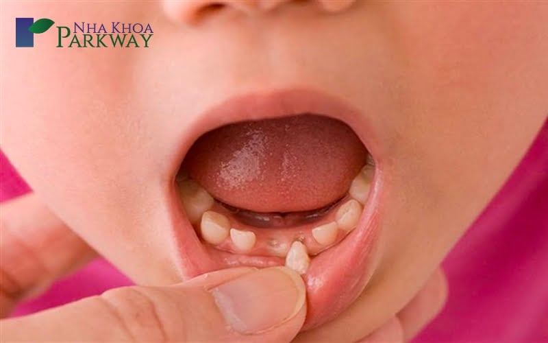 Hình ảnh cả 2 chiếc răng cửa hàm dưới của trẻ bị gãy