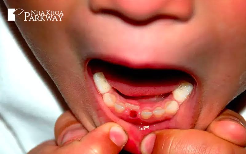 Trẻ nhỏ bị nhổ một chiếc răng cửa ở hàm dưới
