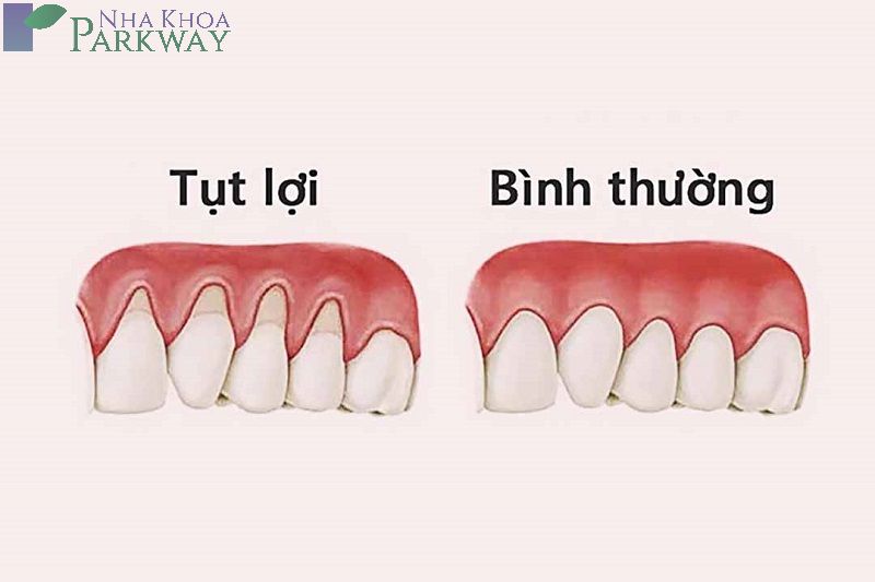 Hình ảnh so sánh răng bị tụt lợi và răng bình thường