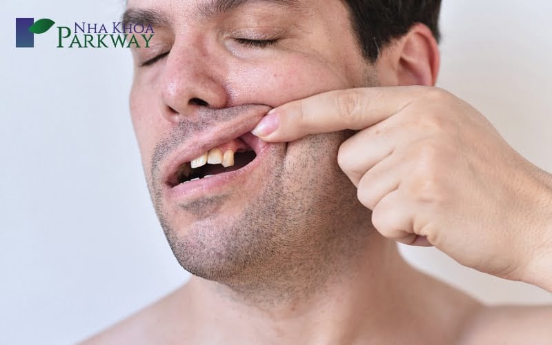 Những nguyên nhân dẫn đến việc gãy răng