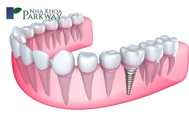 Cách khắc phục hiệu quả tình trạng gãy răng hàm tại nha khoa