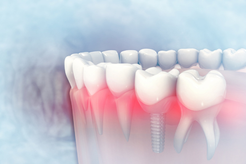 Hình ảnh so sánh giữa răng trồng implant và chân răng bình thường