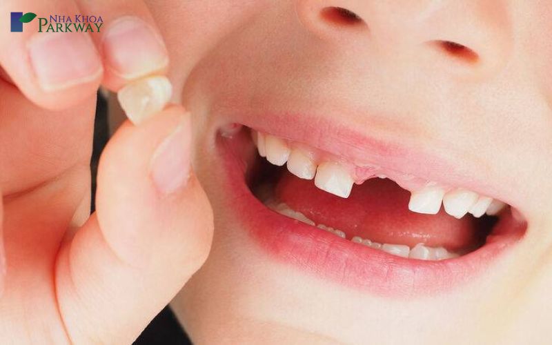 Răng trẻ bị mọc lệch do không nhổ răng sữa đúng thời điểm