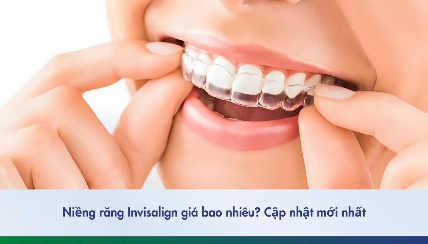 Giá niềng răng Invisalign