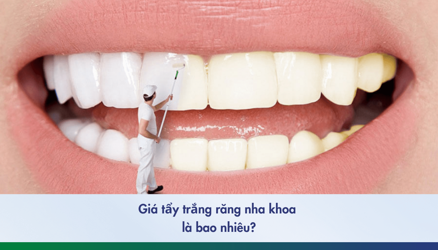 Giá tẩy trắng răng nha khoa