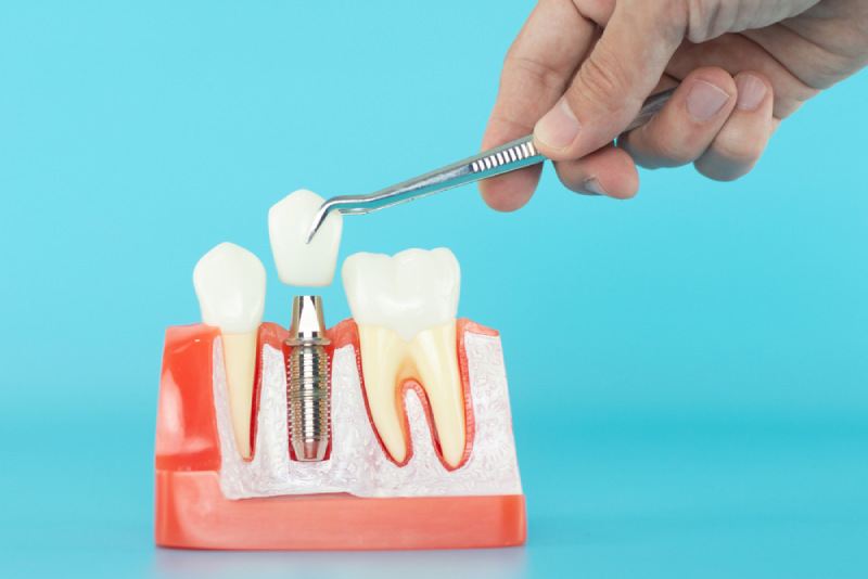 Cách thực hiện trồng răng implant được mô phỏng trên mô hình