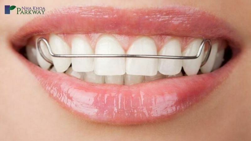 Hàm duy trì sẽ đảm bảo hiệu quả niềng răng được tốt nhất
