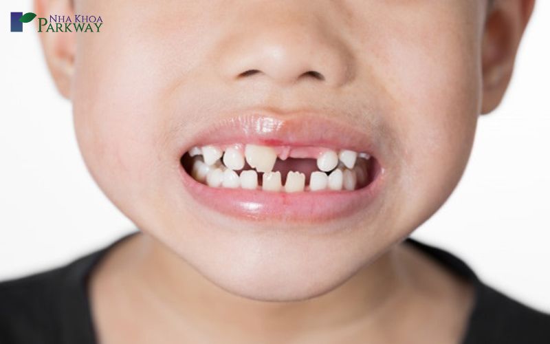 Trẻ em bị rụng răng cửa hàm trên