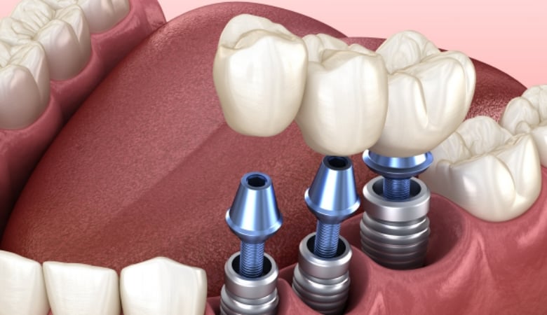 Làm cách nào để giảm sưng sau khi trồng răng implant