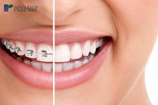 Hạn chế tác hại của niềng răng bằng cách lựa chọn đơn vị niềng răng uy tín