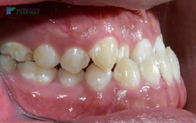 Hàm móm là răng hàm dưới nhô ra trước