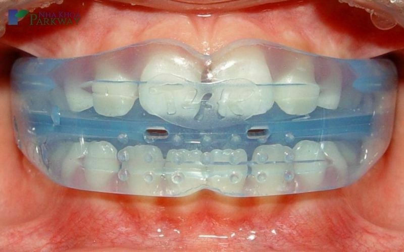 Hình ảnh răng miệng của khách hàng đang mang hàm trainer