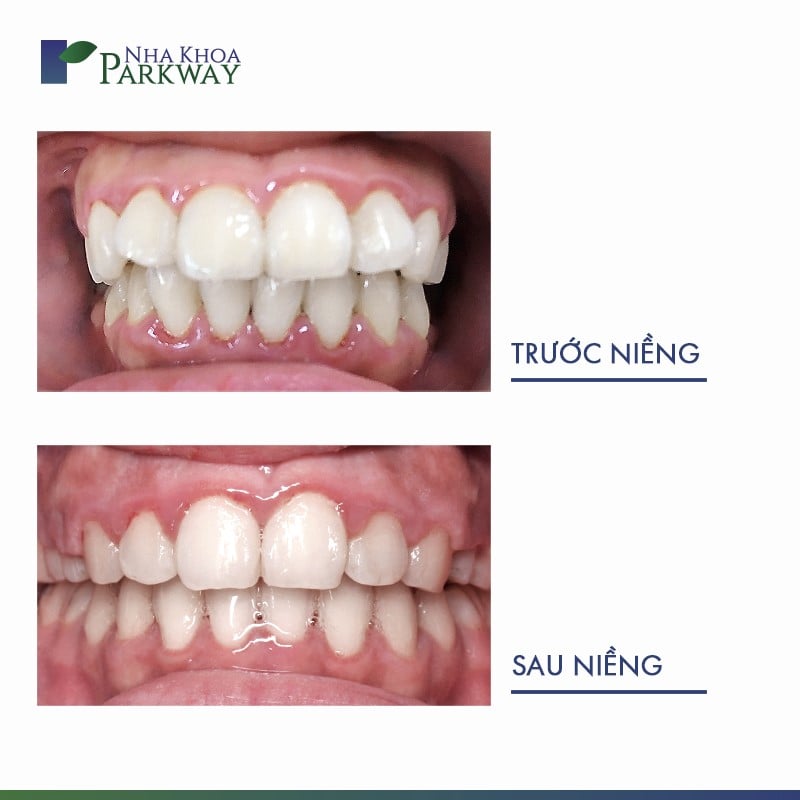 Hình ảnh hàm răng trước và sau khi niềng invisalign
