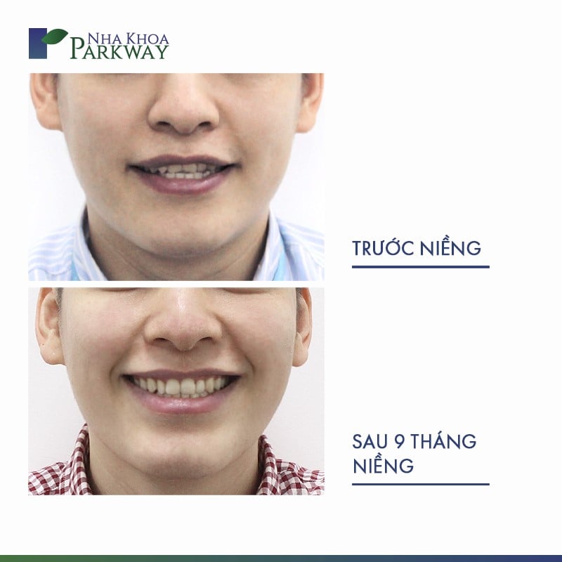 Gương mặt trước và sau khi niềng răng mắc cài