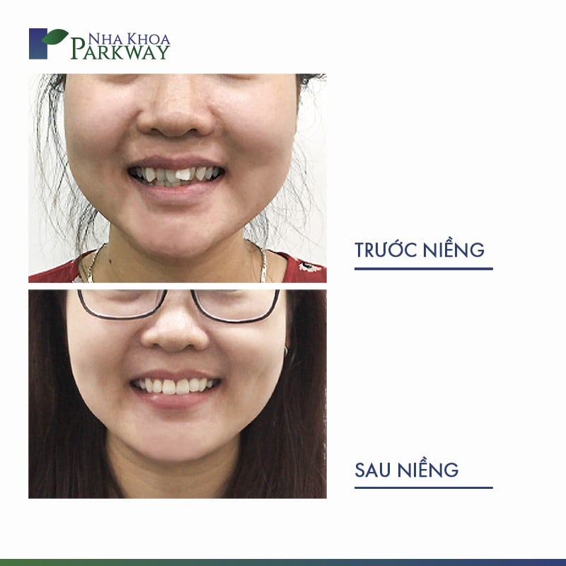 Gương mặt cô gái trước và sau khi niềng răng