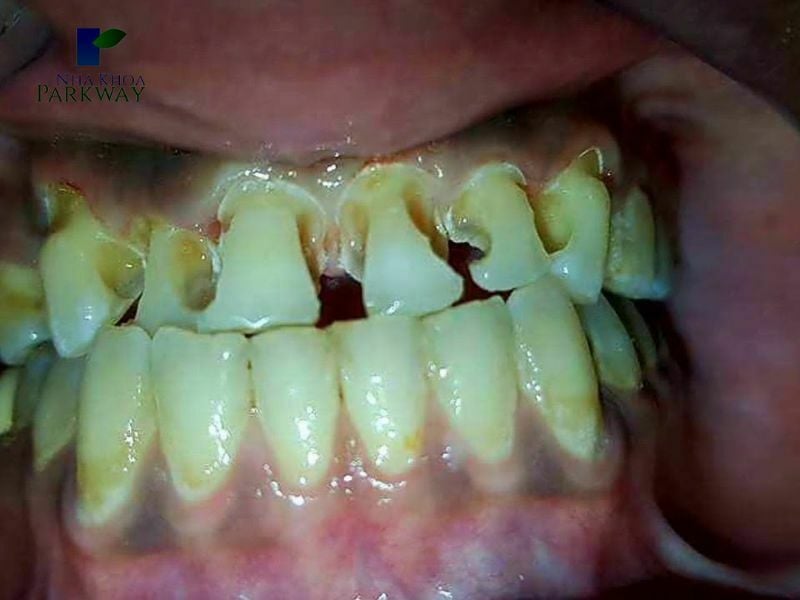 Hàm răng ố vàng và bị sâu răng nặng
