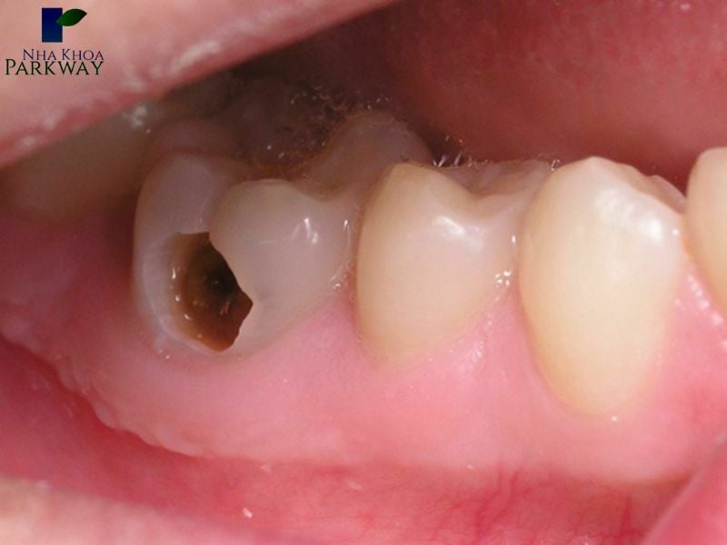 Sâu răng nặng khiến răng bị nứt và xuất hiện lỗ hổng lớn