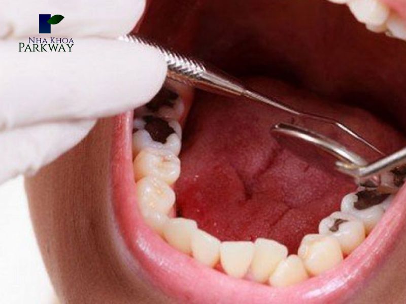 Sử dụng gương và dụng cụ nha khoa để kiểm tra răng sâu