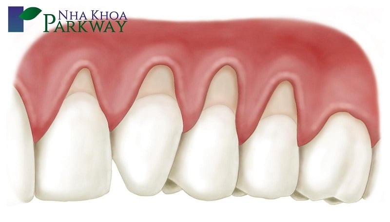 Tình trạng tụt lợi hở chân răng phổ biến trong nha khoa
