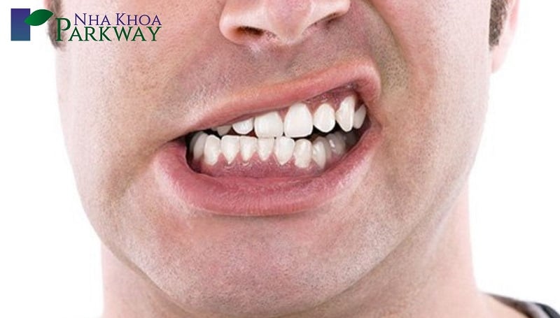 Nghiến răng hay cắn những vật dụng cứng tạo nên áp lực không cân đối lên răng