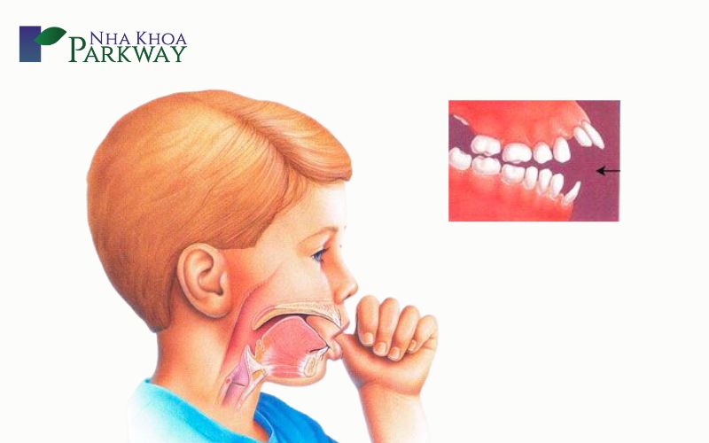 Nguyên nhân răng bị hô hàm là gì? 