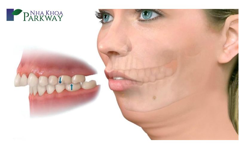 Nguyên nhân răng bị hô hàm là gì? 