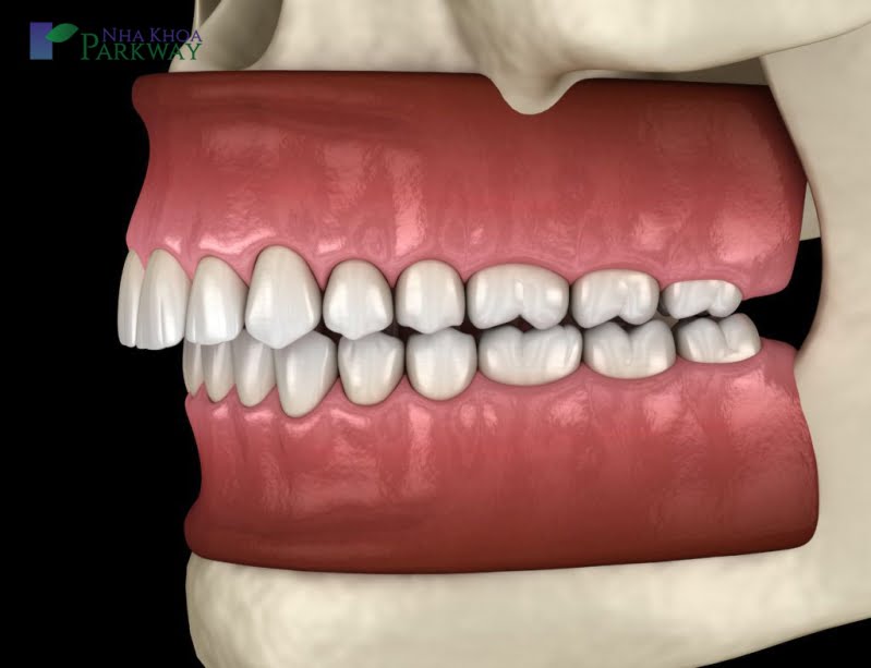 Giới thiệu sơ về xương ổ răng