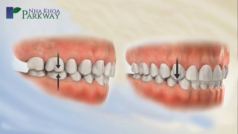 Hô xương ổ răng là gì?