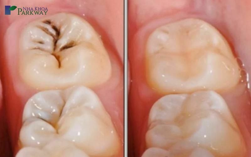 Hình ảnh so sánh trước và sau khi trám răng