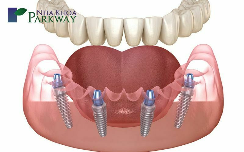 Phương pháp trồng răng giả implant với kỹ thuật All-On-4