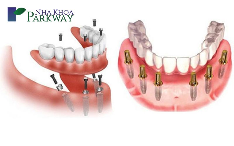 hình ảnh so sánh sự khác nhau giữa phương pháp trồng răng implant All-on-4 và All-on-6