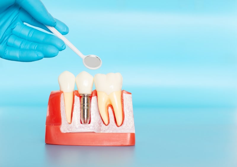 Mô hình những chiếc răng thật và răng được trồng bằng phương pháp Implant