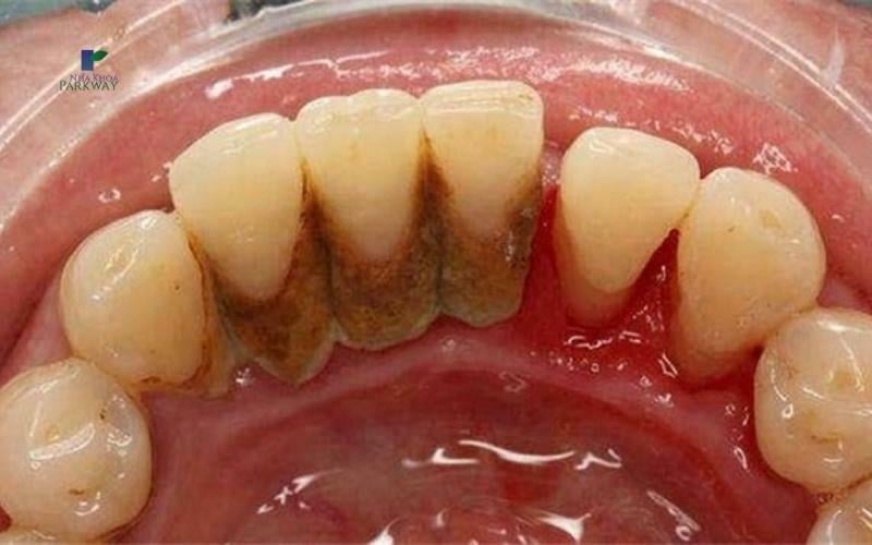 Hình ảnh mặt trong của hàm đang có nhiều vôi răng chưa được làm sạch