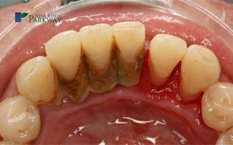 Hình ảnh răng bị ố vàng và có nhiều mảng bám