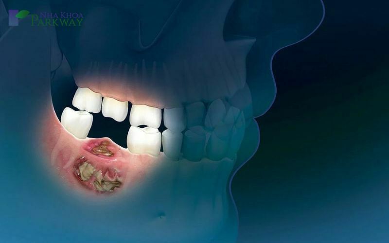 Hình ảnh chân răng bị viêm tủy hoại tử tạo ổ áp xe