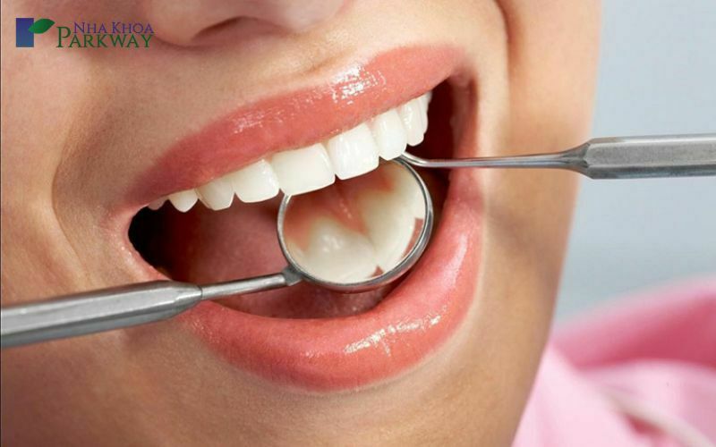 Bác sĩ dùng gương nha và dụng cụ khám răng cửa sau khi điều trị sâu răng
