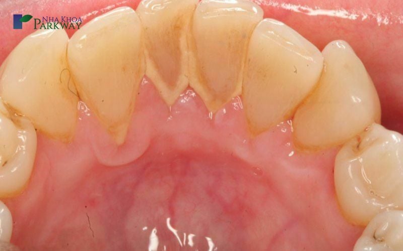 Mặt trong răng có nhiều vôi răng, mảng bám