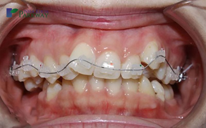 Hình ảnh niềng răng có dấu hiệu bị hỏng, biến dạng