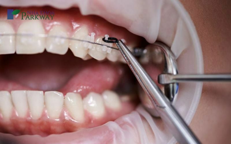 Dùng kiềm nha khoa để gắn loop đóng khoảng răng